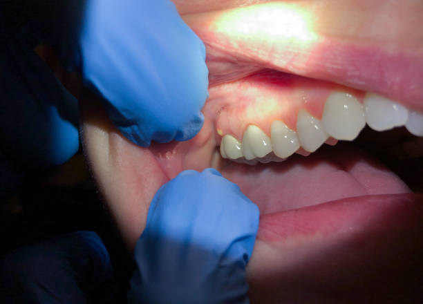 Best Emergency Dentist for Knocked-Out Tooth in Elmo, TX